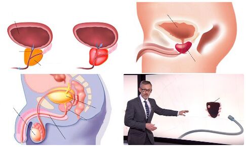 здаровая і хворая прастата